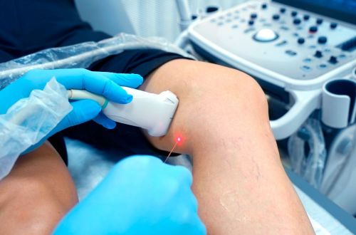 ЕВЛК - малоінвазивний метод лікування варикозу